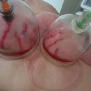 Blood cupping