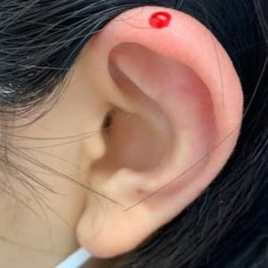 Ear tip bloodletting therapy